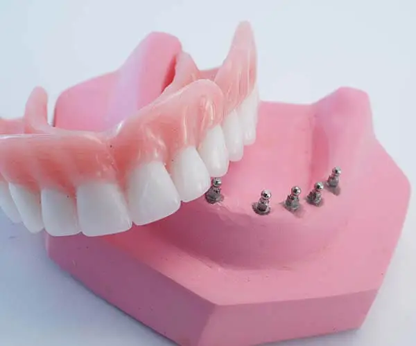 پرتز دندان