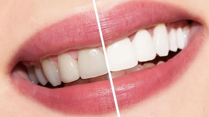 سفید کردن دندان