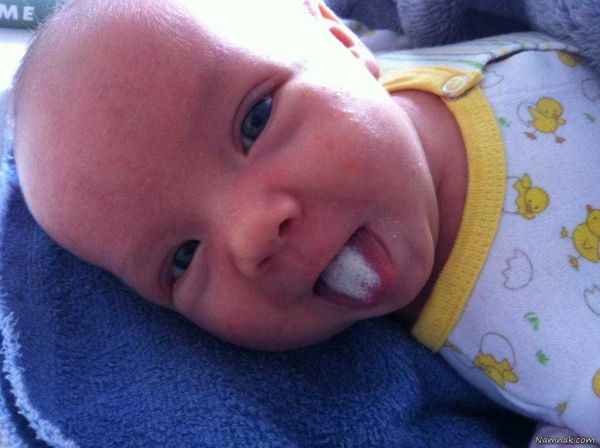 علائم و نشانه های برفک دهان نوزادان