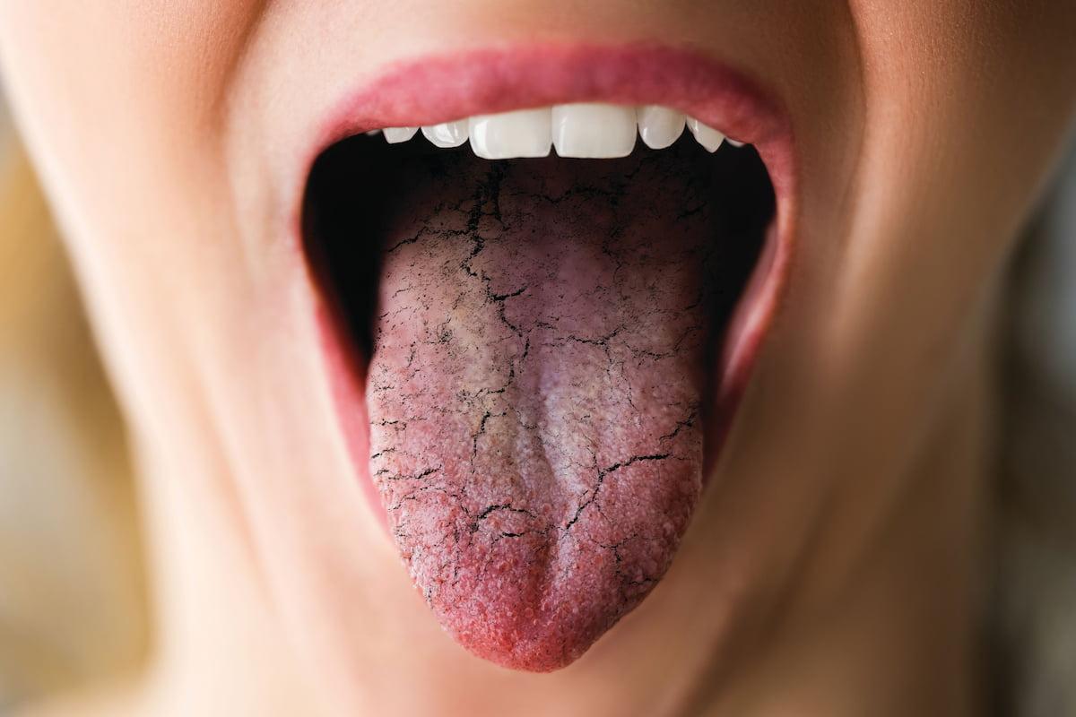 علائم و نشانه های خشکی دهان کدامند؟