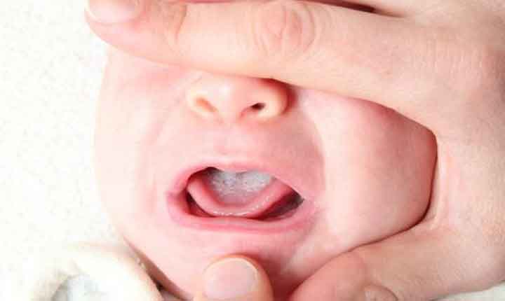 روش های درمان برفک دهان نوزاد