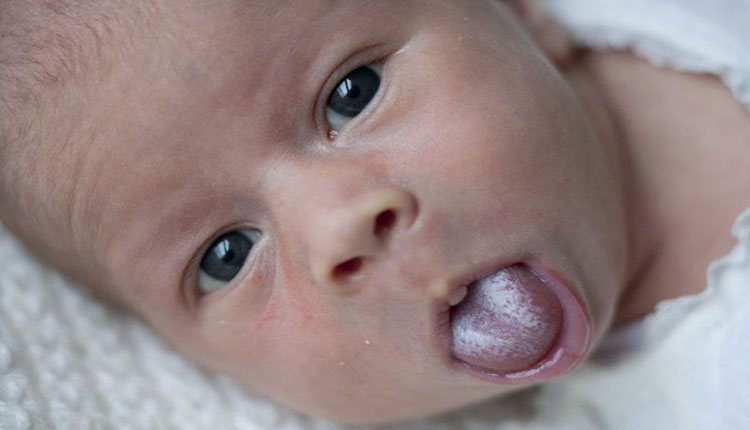 راه های پیشگیری از بروز برفک دهان نوزاد