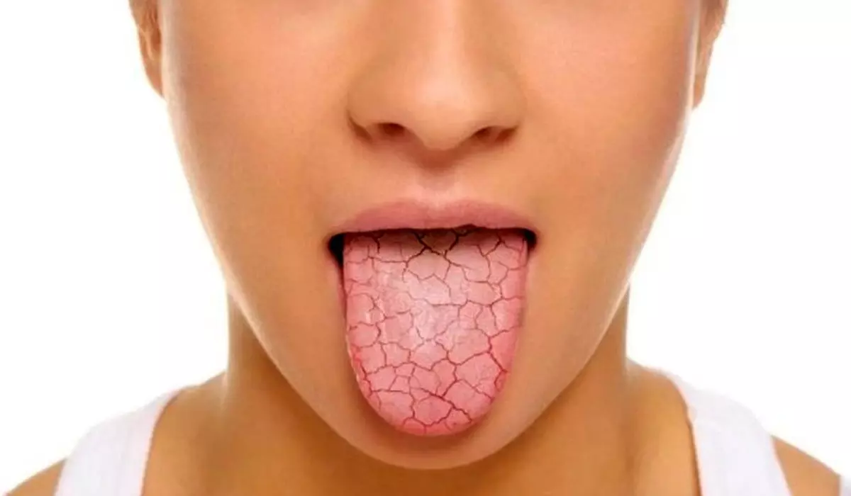 روش های پیشگیری از خشکی دهان