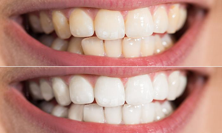 مزیت های استفاده از روش های مراقبتی سفیدکردن دندان ها