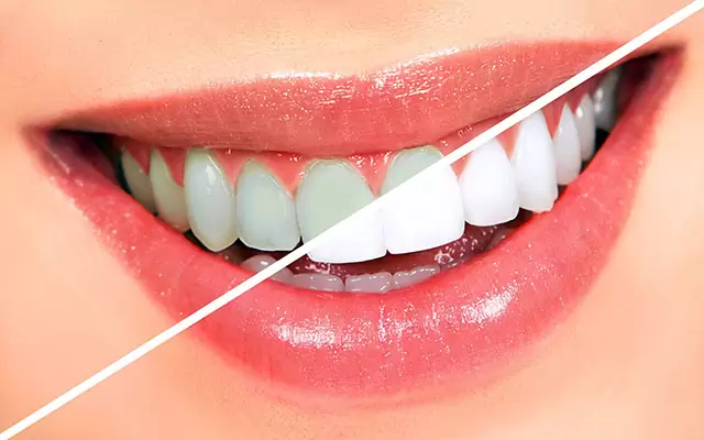 عوارض سفید کردن دندان ها