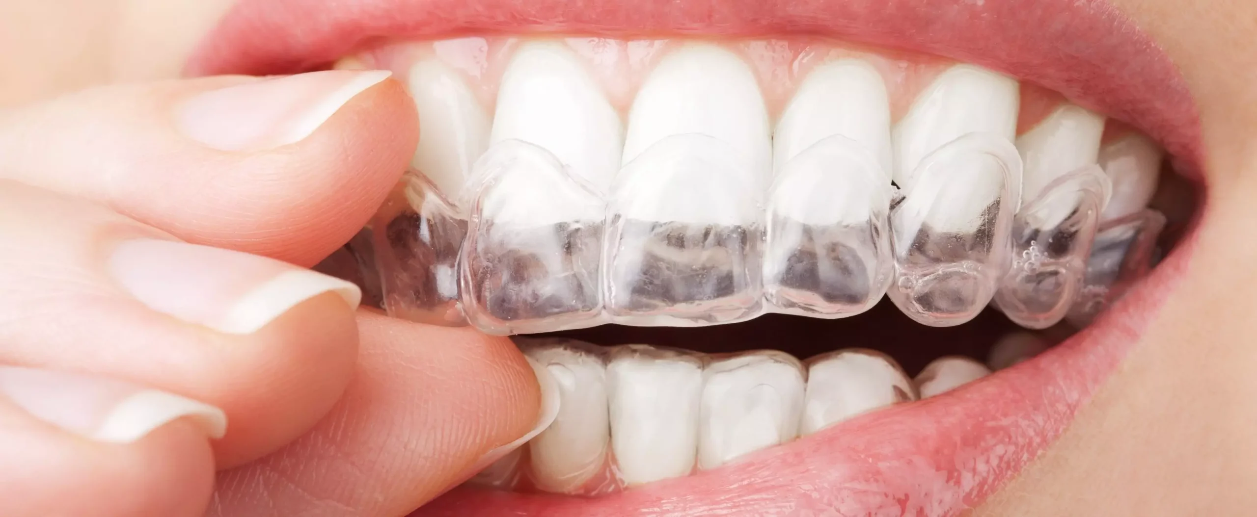 عوارض سفید کردن دندان‌