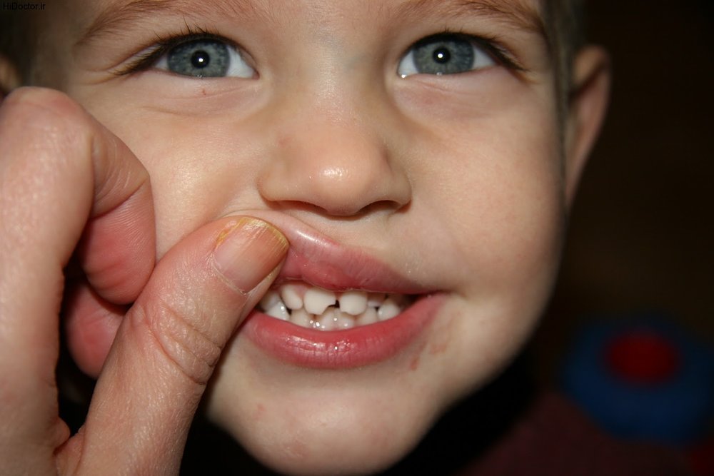 آیا جویدن آدامس از دندان های کودکان مراقبت می کند؟